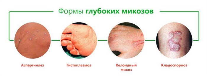 формы микозов